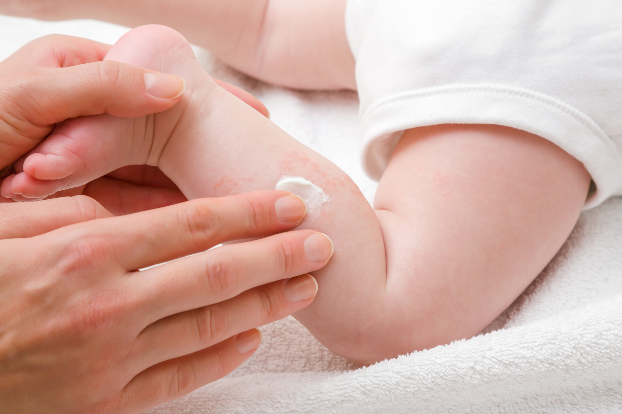 eczema in babies treatment