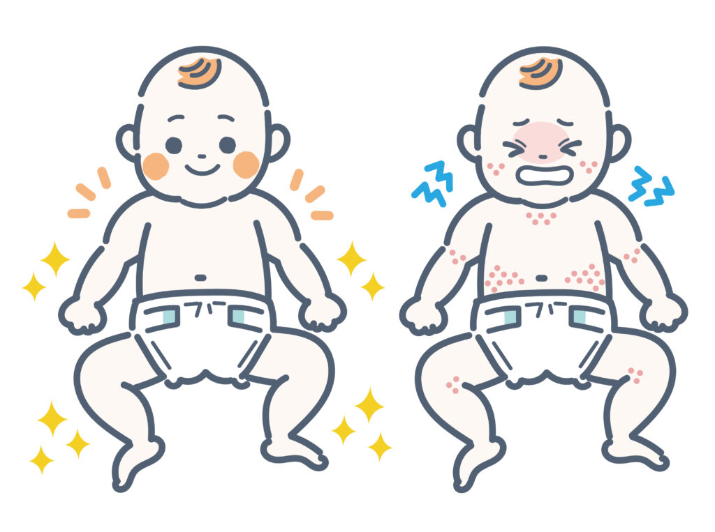 Eczema in babies 